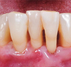 after periodontal